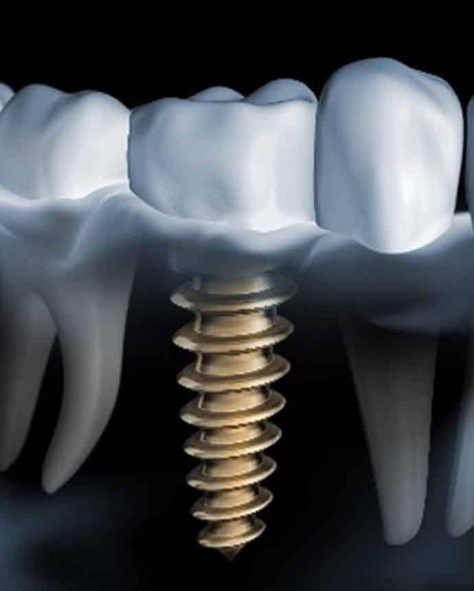 Digital model of single tooth implant