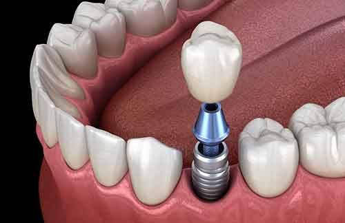 Model showing each part of a dental implant