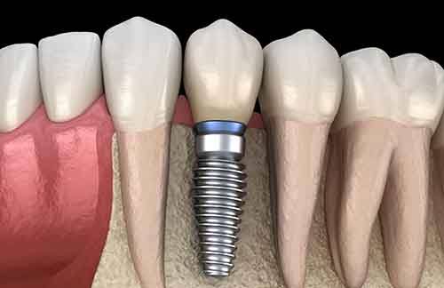 Model of dental implant replacing lower tooth