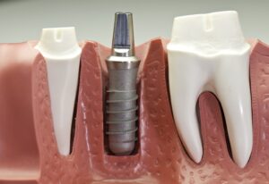 Model of dental implant post in bone